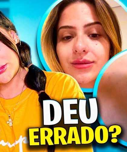 TIREI MINHA HARMONIZAÇÃO FACIAL? 🥺