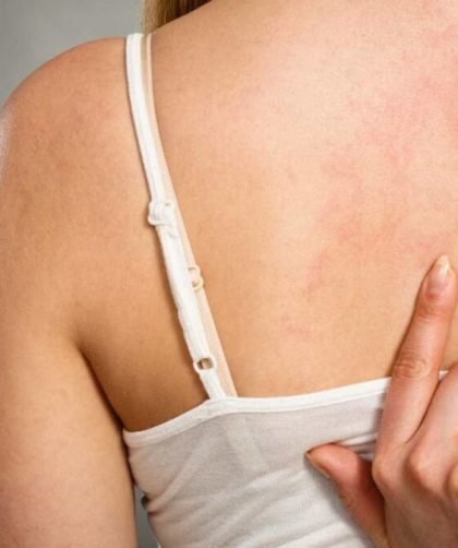 Alergia ao sol – Sintomas, causas, tratamentos e prevenção