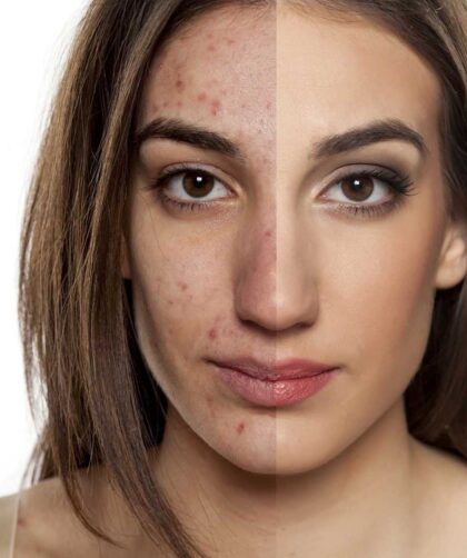 Espinhas hormonais – Influência dos hormônios sobre a pele Espinhas hormonais – Influência dos hormônios sobre a pele