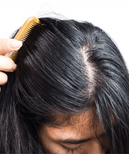 Cabelo oleoso – Causas, cuidados e formas de acabar com a oleosidade