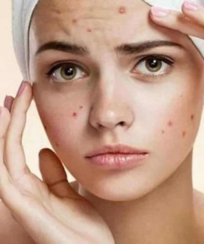 Manchas de acne – Dicas do que fazer para clarear e prevenir as marcas