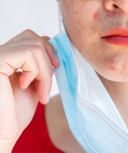 Maskne, o que é? Dicas de como prevenir a acne causada pela máscara