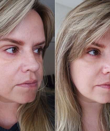 meu antes e depois do procedimento de lifting facial