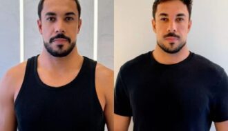 Ex-BBB Maike Allan faz harmonização facial e explica receio de perder a naturalidade