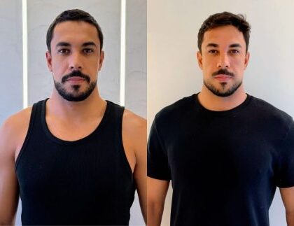 Ex-BBB Maike Allan faz harmonização facial e explica receio de perder a naturalidade