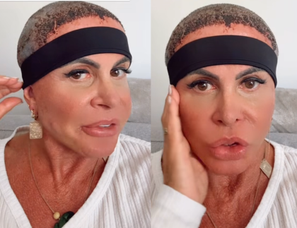 Gretchen atualiza sobre recuperação após realizar transplante capilar