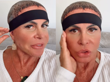 Gretchen atualiza sobre recuperação após realizar transplante capilar