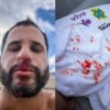 Ítalo Ferreira sofre acidente em treino e leva pontos no nariz: “Dor que não desejo pra ninguém”