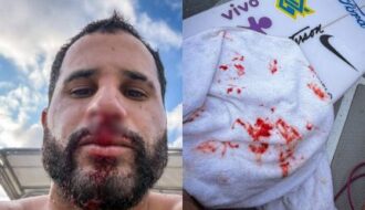 Ítalo Ferreira sofre acidente em treino e leva pontos no nariz: “Dor que não desejo pra ninguém”