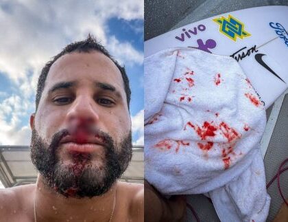 Ítalo Ferreira sofre acidente em treino e leva pontos no nariz: “Dor que não desejo pra ninguém” Ítalo Ferreira sofre acidente em treino e leva pontos no nariz: “Dor que não desejo pra ninguém”