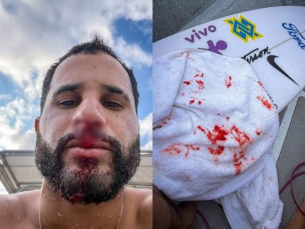Ítalo Ferreira sofre acidente em treino e leva pontos no nariz: “Dor que não desejo pra ninguém”