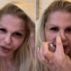 Monique Evans mostra rosto sete dias após cirurgia plástica: “Estou apaixonada”