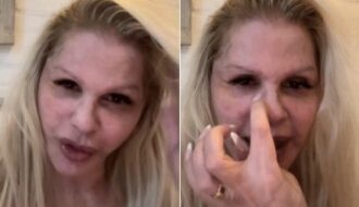 Monique Evans mostra rosto sete dias após cirurgia plástica: “Estou apaixonada”