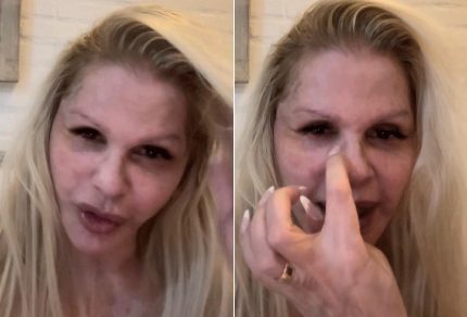 Monique Evans mostra rosto sete dias após cirurgia plástica: “Estou apaixonada”