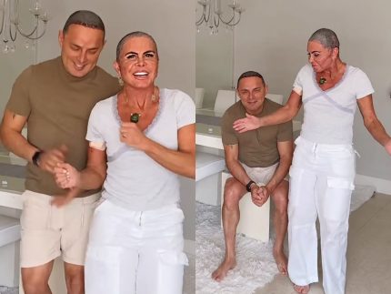 Gretchen revela que marido também fez transplante capilar: “Vai ficar com franjão”