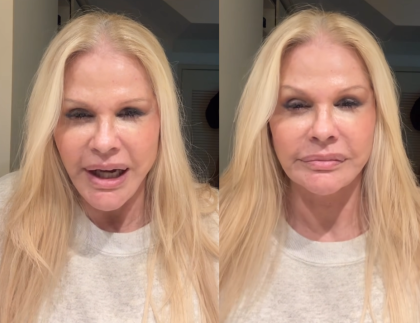 Monique Evans comemora resultado de cirurgia facial: “Chocada com a minha cara” Monique Evans comemora resultado de cirurgia facial: “Chocada com a minha cara”